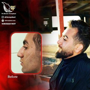 جراحی-بینی-38