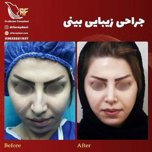 جراحی-بینی-4
