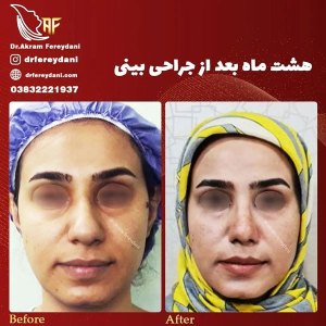جراحی-بینی-40