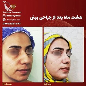 جراحی-بینی-41