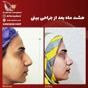 جراحی-بینی-42