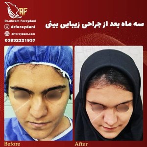 جراحی-بینی-43