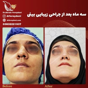 جراحی-بینی-44