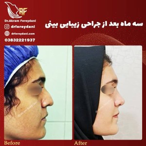 جراحی-بینی-45
