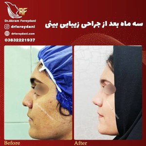 جراحی-بینی-46