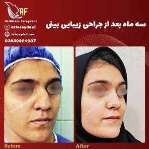 جراحی-بینی-47