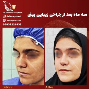جراحی-بینی-48