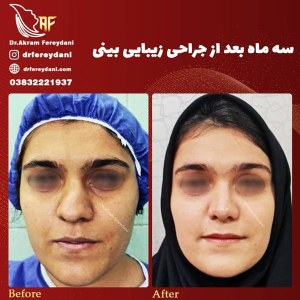 جراحی-بینی-49