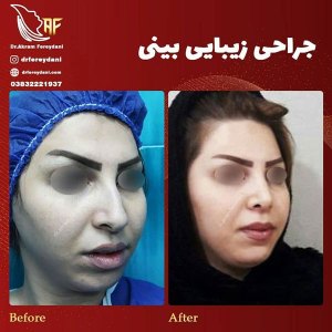 جراحی-بینی-5