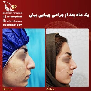 جراحی-بینی-50
