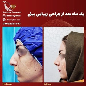 جراحی-بینی-51