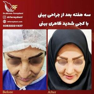 جراحی-بینی-52