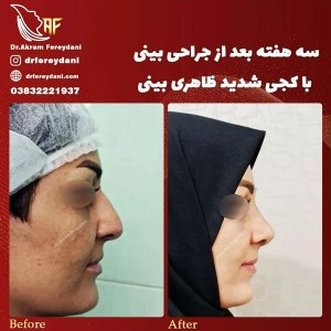 جراحی-بینی-53