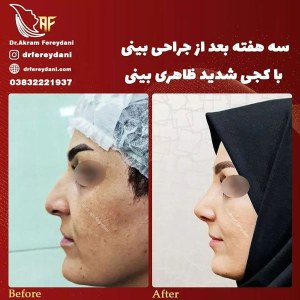 جراحی-بینی-54