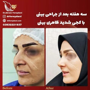 جراحی-بینی-55