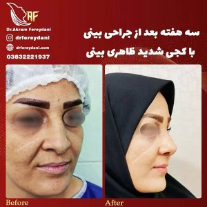 جراحی-بینی-56