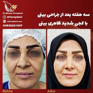 جراحی-بینی-57