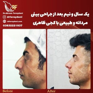 جراحی-بینی-58