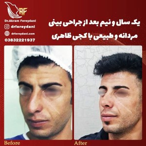 جراحی-بینی-59