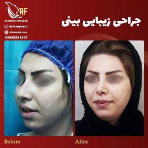 جراحی-بینی-6