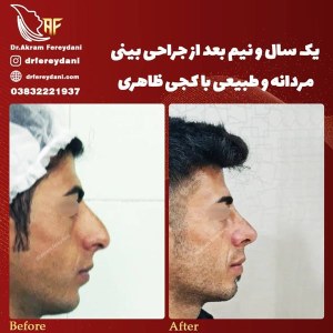 جراحی-بینی-60