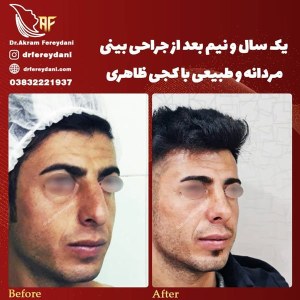جراحی-بینی-61