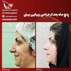 جراحی-بینی-62