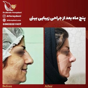 جراحی-بینی-63