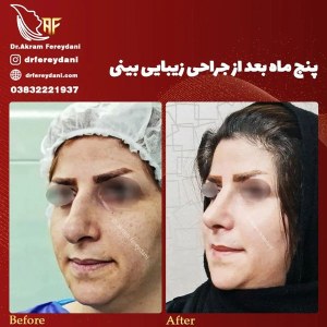 جراحی-بینی-64