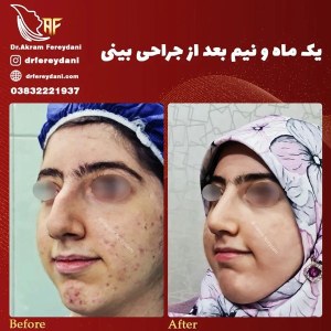 جراحی-بینی-65