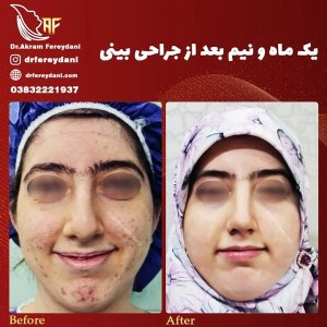 جراحی-بینی-66