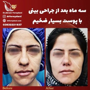 جراحی-بینی-67