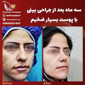 جراحی-بینی-68