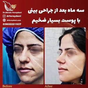 جراحی-بینی-69