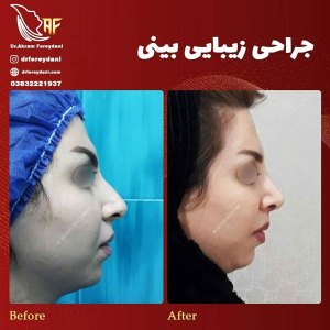 جراحی-بینی-7