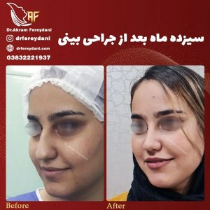 جراحی-بینی-71