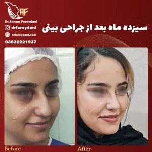 جراحی-بینی-72