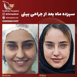 جراحی-بینی-73