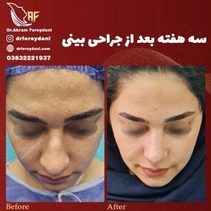 جراحی-بینی-74