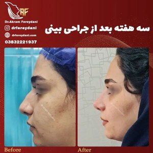 جراحی-بینی-75