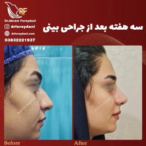 جراحی-بینی-76