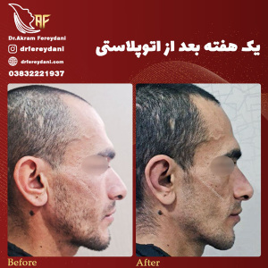 جراحی-بینی-78