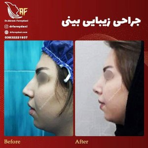 جراحی-بینی-8