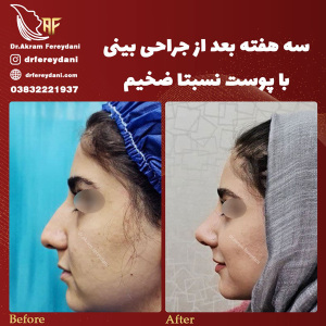 جراحی-بینی-81