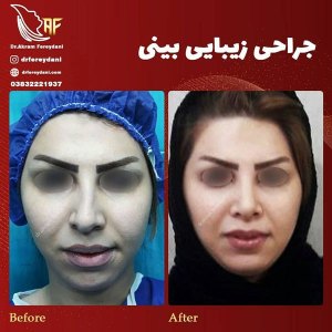جراحی-بینی-9