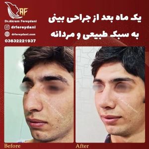 جراحی-بینی-93