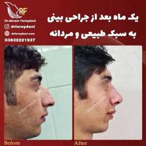 جراحی-بینی-95