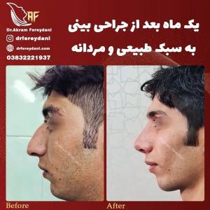 جراحی-بینی-96