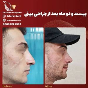 جراحی-بینی-97