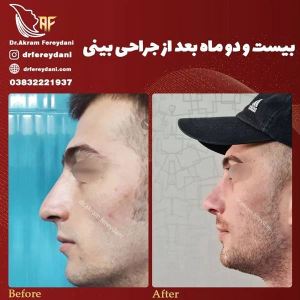 جراحی-بینی-98